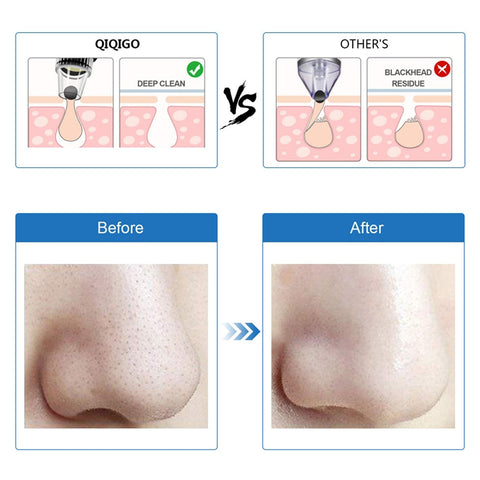 Blackhead Remover Face Cleaner Machine